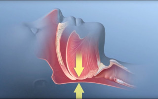 apnea ostruttiva